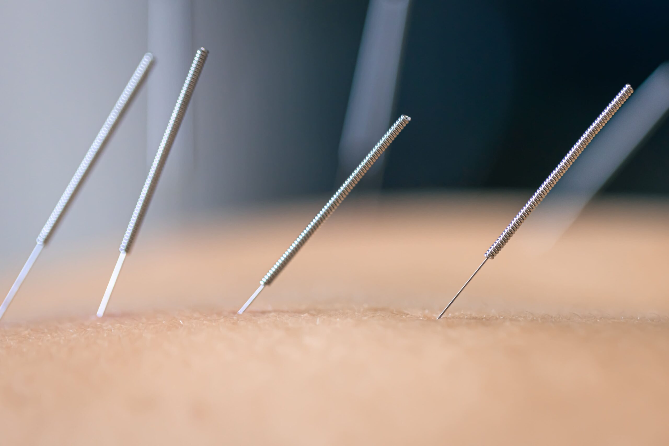 dry needling vs acupuncture