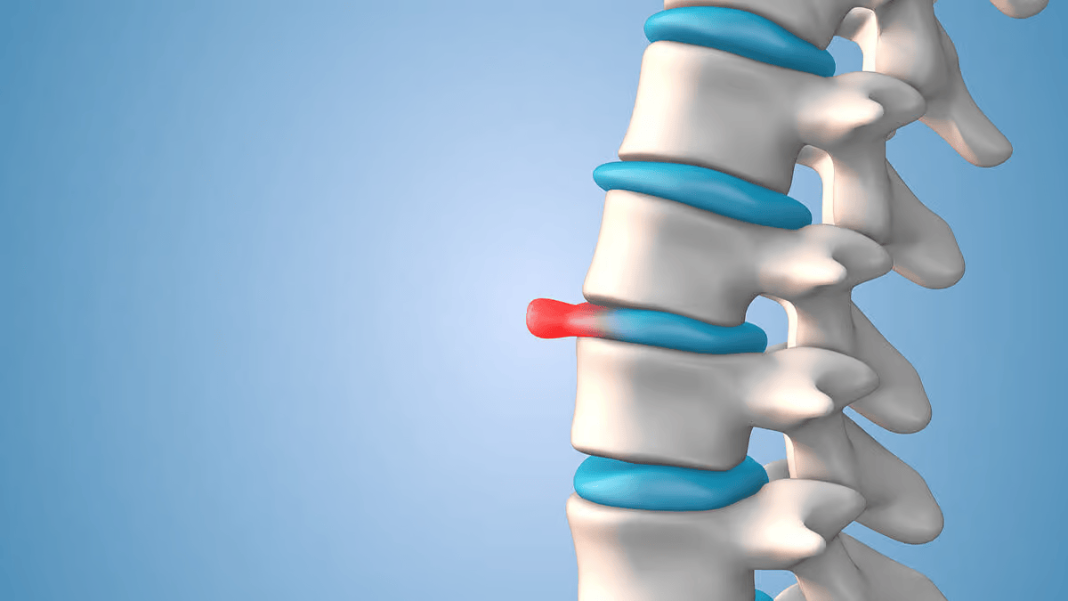 physiotherapy for slip disc