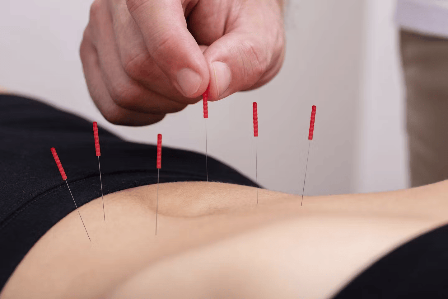dry needling near me