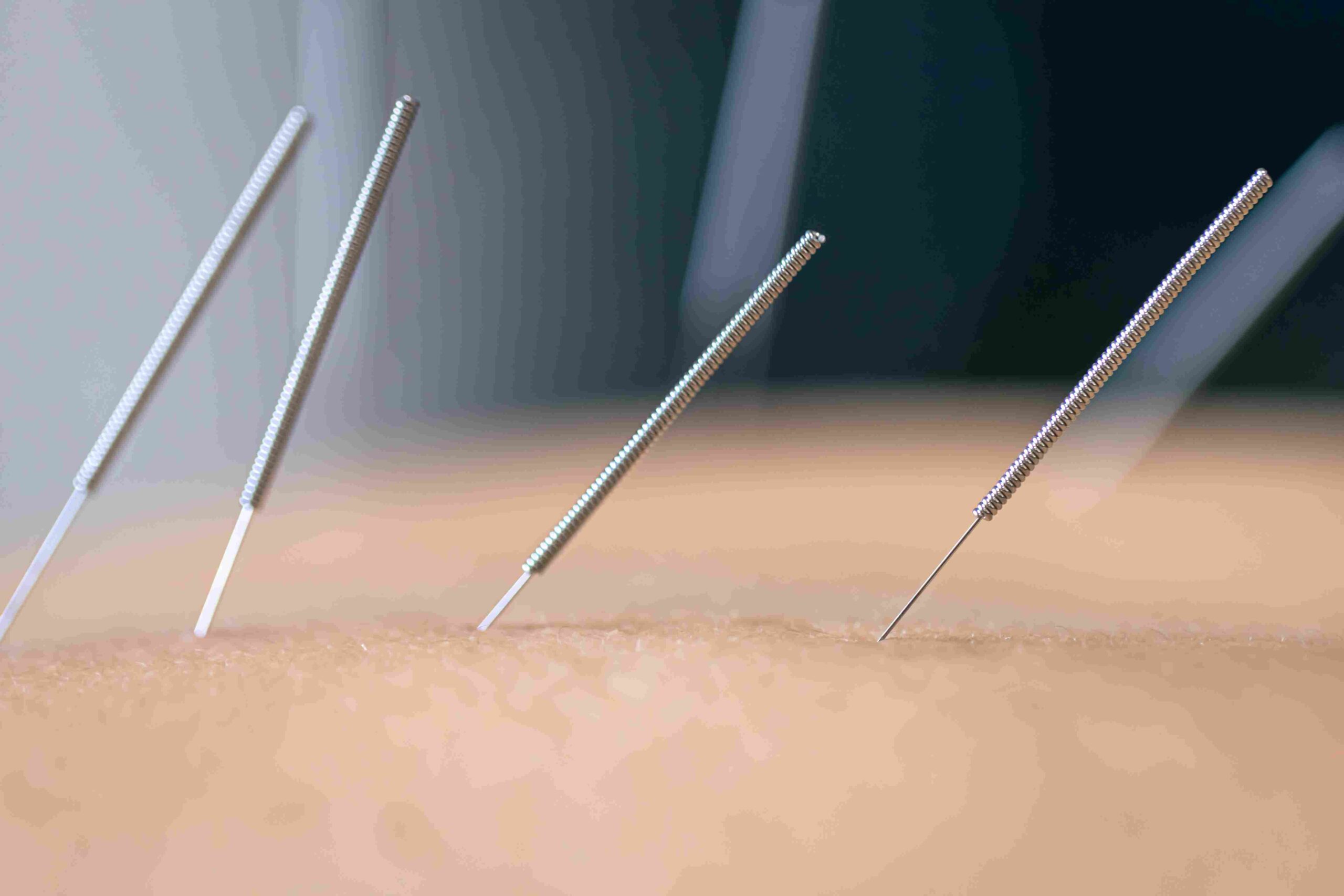 dry needling near me
