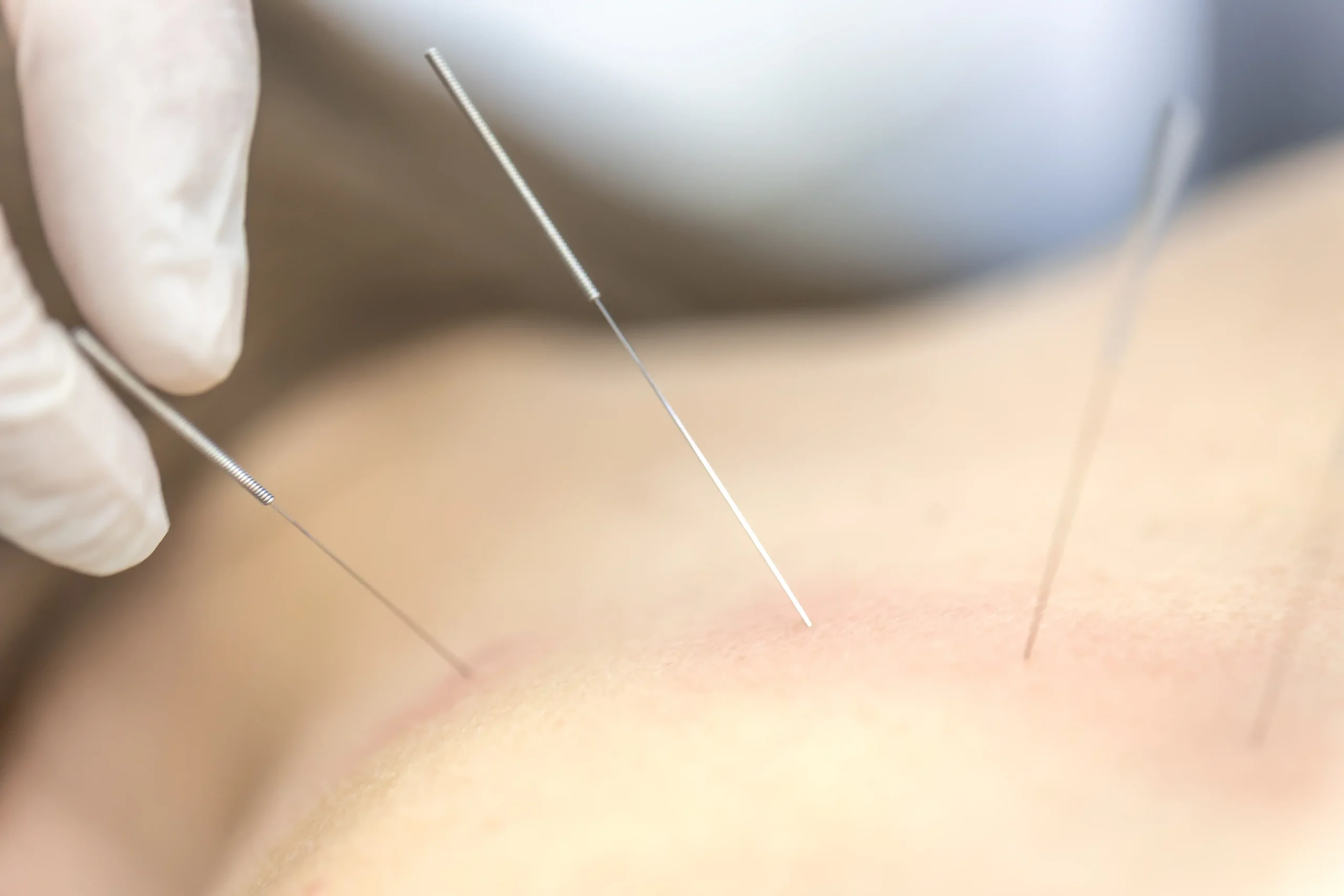 dry needling near me