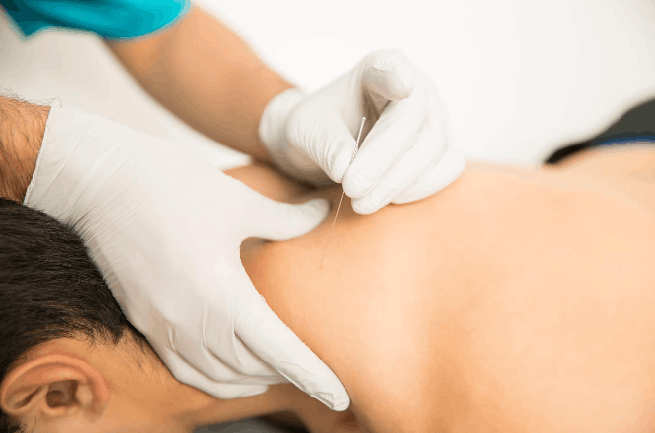 patient receiving dry needling treatment