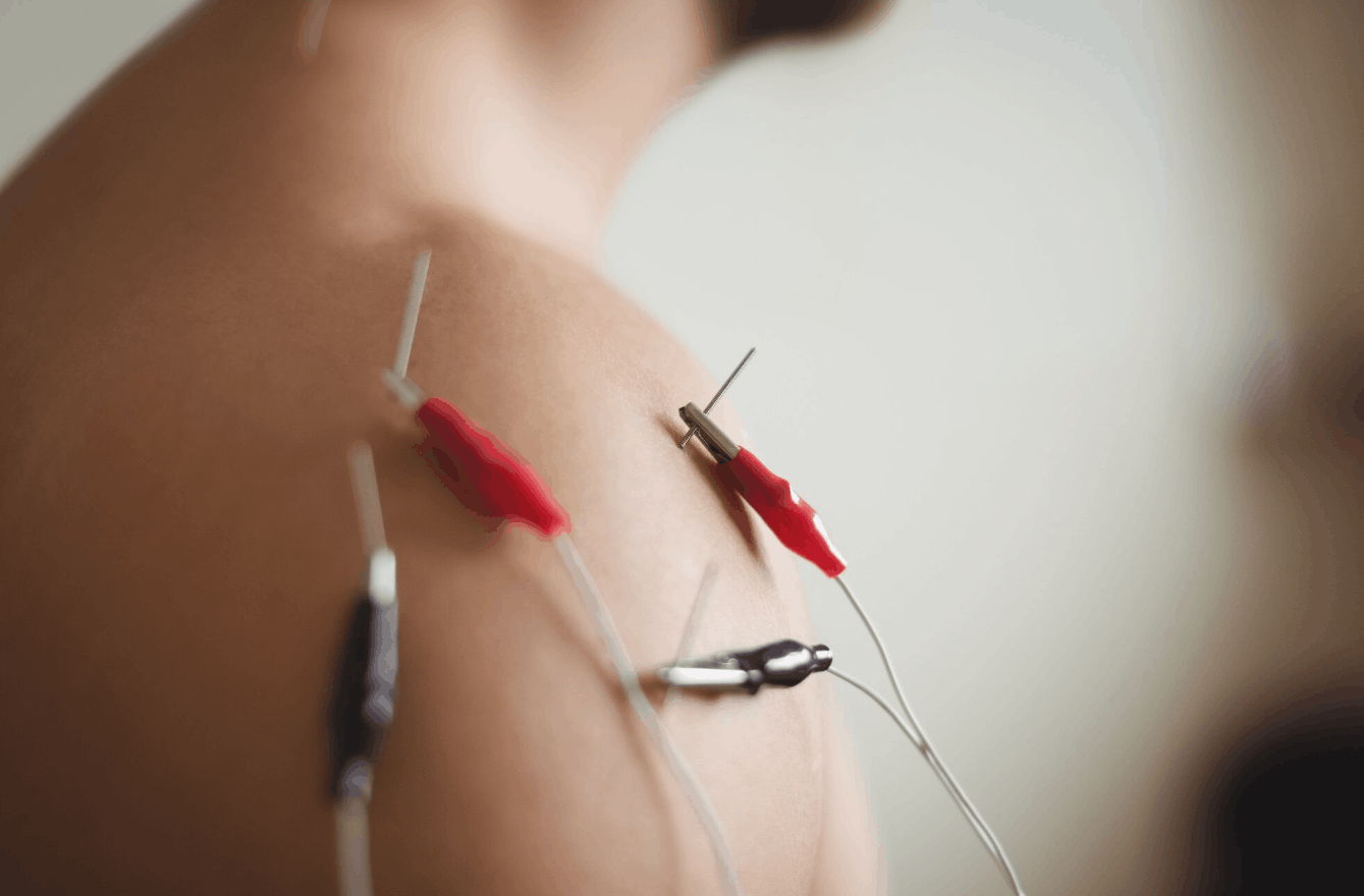 patient with needles in his shoulder with electrical clamps
