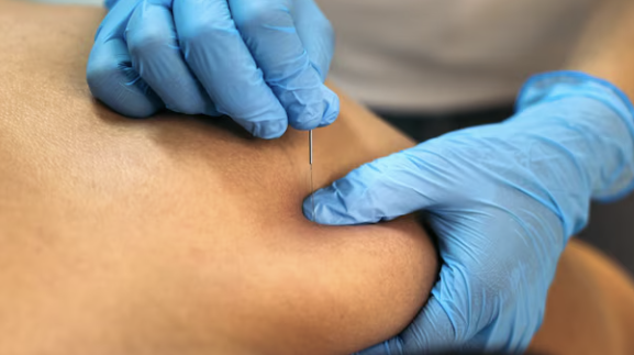 physiotherapist doing a dry needling treatment